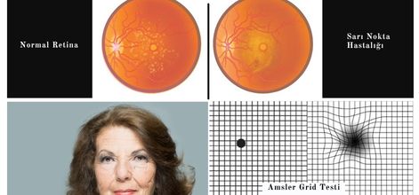 Ertelenmeyecek Göz Hastalıkları Sarı Nokta Hastalığı